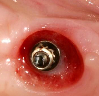 Gingiva LTS-BASE Gingiva LTS-BASE