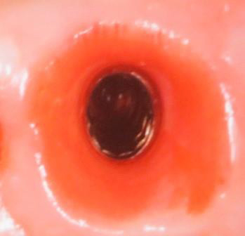 Gingiva traditionell Gingiva traditionell