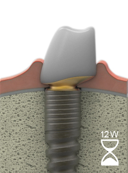 LTS-Hybride-Abutment after healing