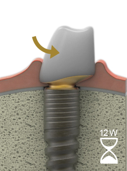 LTS-Hybride-Abutment after healing