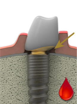 LTS-Hybride-Abutment at the time of implantation LTS-Hybride-Abutment at the time of implantation