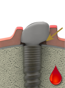 LTS-healingcap at the time of implantation LTS-healingcap at the time of implantation