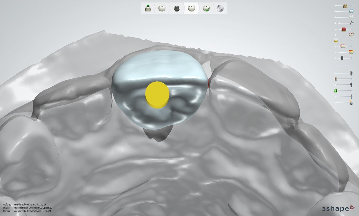 Occlusal: angulated screwchannel (3Shape) lts-Base-anterior-angulated-screwchannel-occlusal