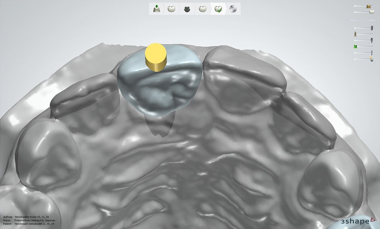 Occlusal: straight screwchannel (3Shape) lts-Base-anterior-straight-screwchannel-occlusal