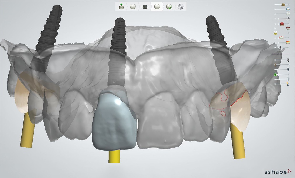 Front: angulated screwchannel (3Shape) lts-base-angulated-screwchannel-front