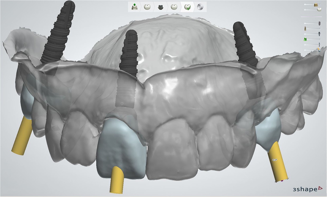Front: straight screwchannel (3Shape) lts-base-straight-screwchannel-front
