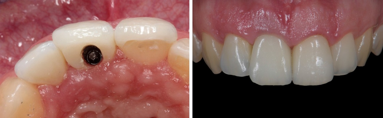 Result with an angulated solution with LTS-BASE LTS-BASE® lts-base-screw-retained-solution
