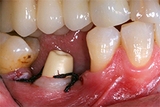 Premolar - lower jaw
